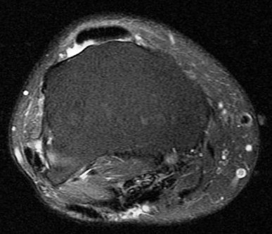 Figure 4 for case aggressive fibromatosis ( RID4292 )